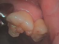 歯間の一部が破折した大臼歯